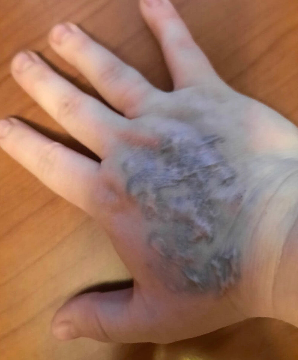 Кожа после удаления татуировки лазером