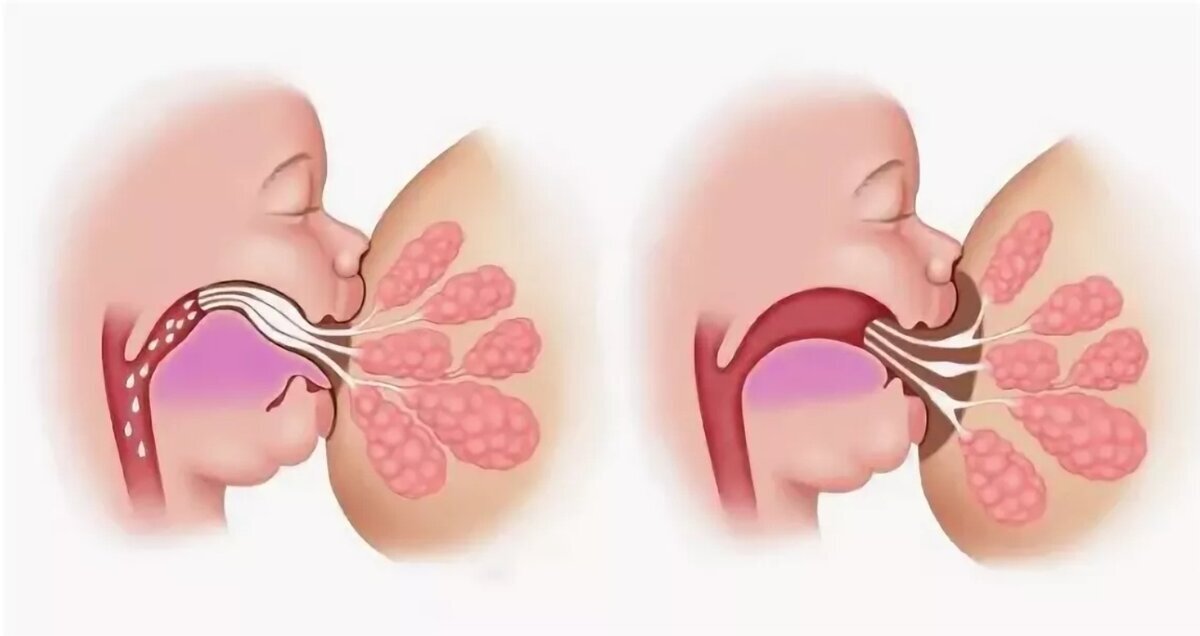 Функция сосания в норме/ с анкилоглоссией 