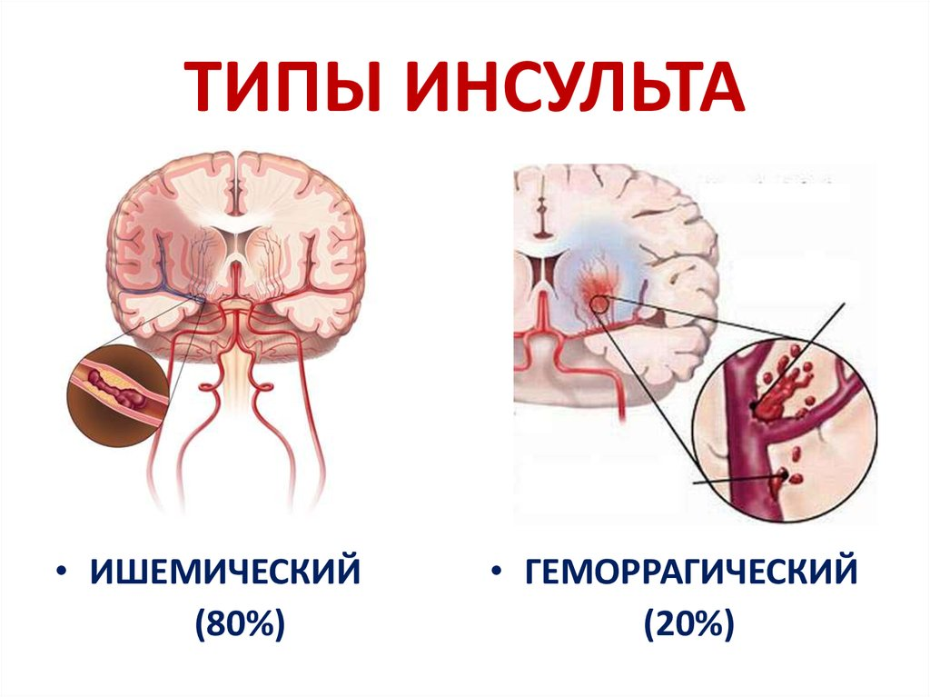 Восстановление после инсульта в домашних условиях