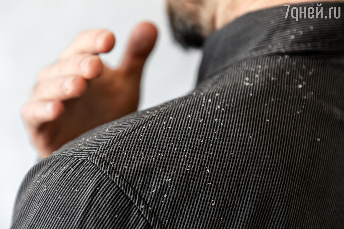    К чему снится перхоть 123RF/legion-media.ru