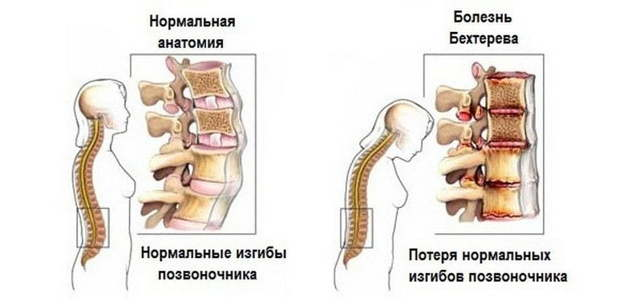 https://xn--3-7sbdco5a0agkeii9o.xn--p1ai/prochee/bolezn-behtereva-ili-ankiloziruyushhij-spondilit-chto-eto-takoe.html