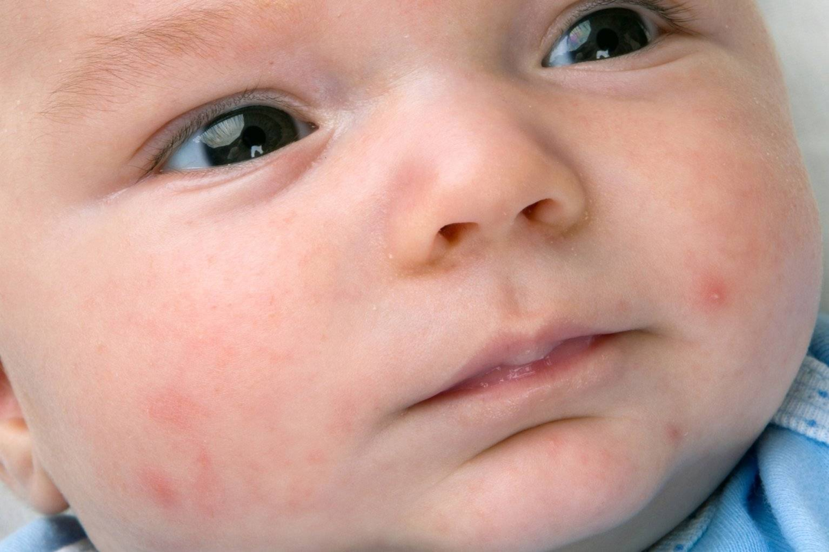 Есть аллергия на гречку. Неонатальный цефалический пустулез. Цефалический пустулез новорожденных. Гнейс атопический дерматит.