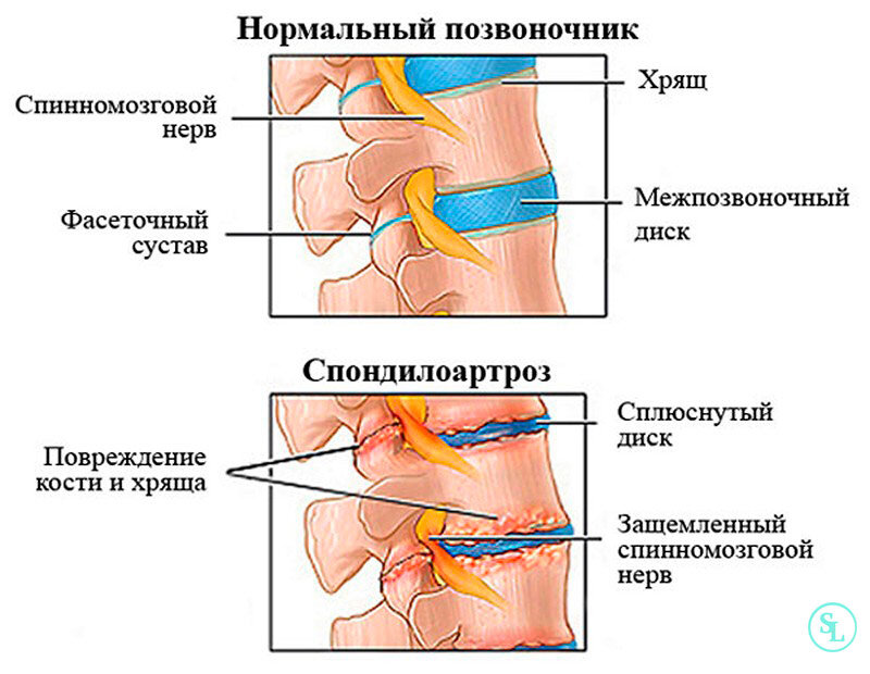 Остеохондроз люмбалгия