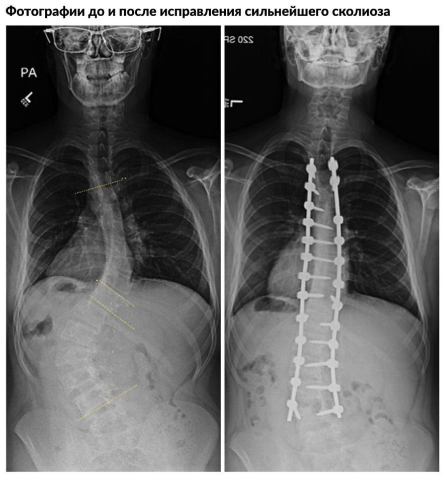 Искривление позвоночника рентген снимок