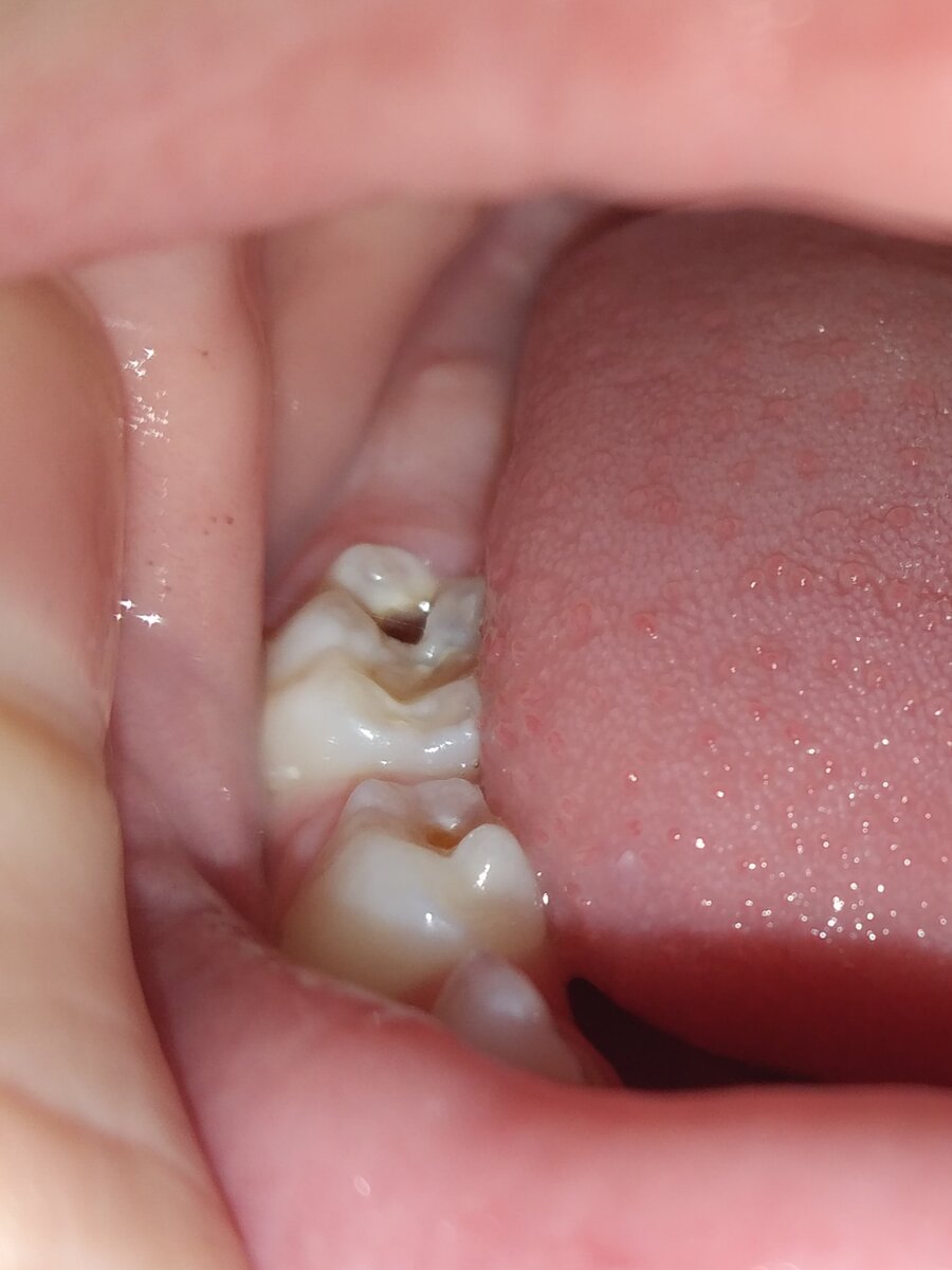 Личное фото. Даже маленькую дырочку на зубе надо лечить