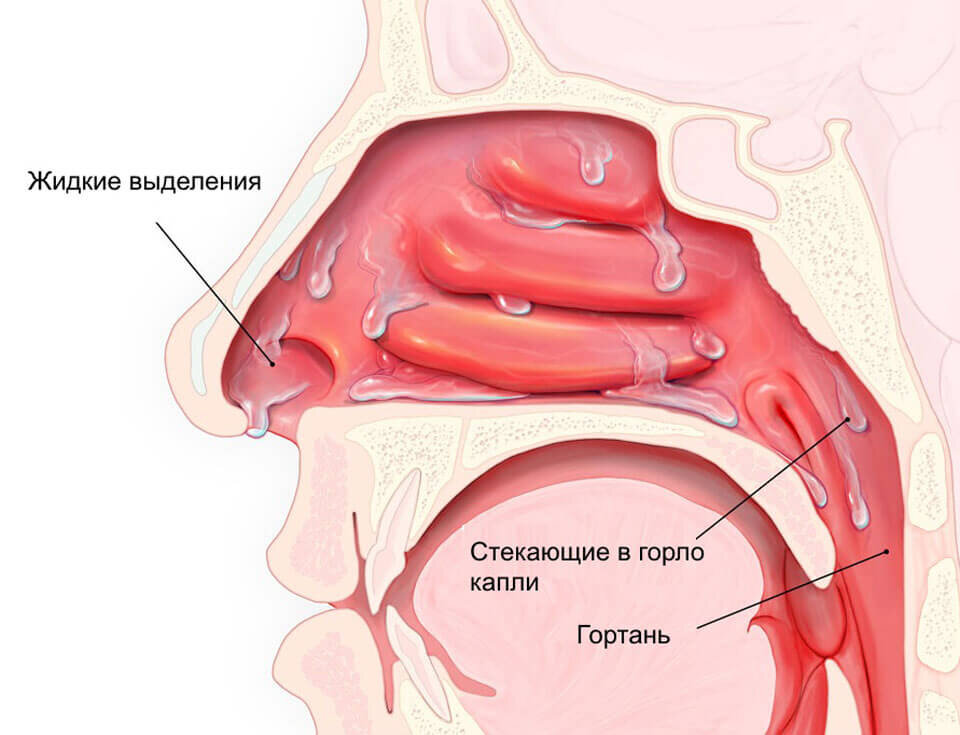 Риноскопическая картина при аллергическом рините