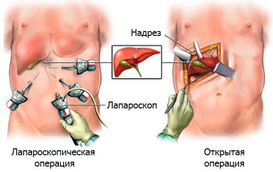 Разница между открытой и лапароскопической операцией