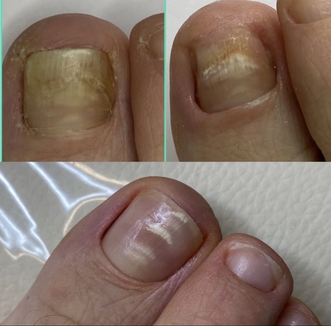 На фото положительная динамика по восстановлению ногтя после онихолизиса, только соблюдая все рекомендации можно добиться превосходных результатов. Динамика за пол года 