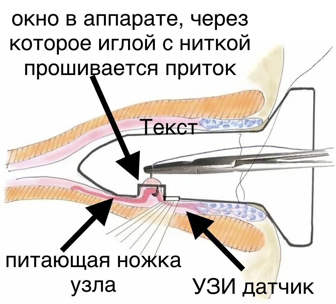 Клизма перед АС