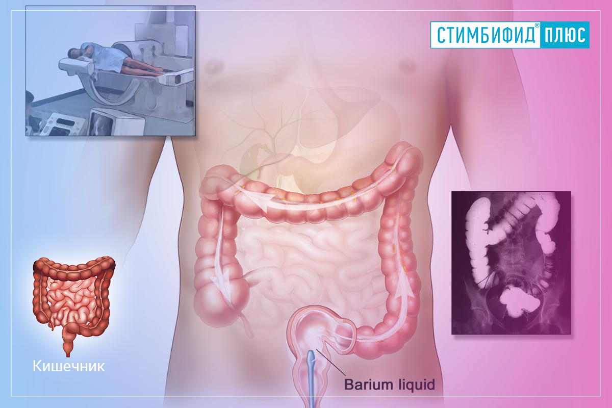 Ирригоскопия кишечника что это и как делают