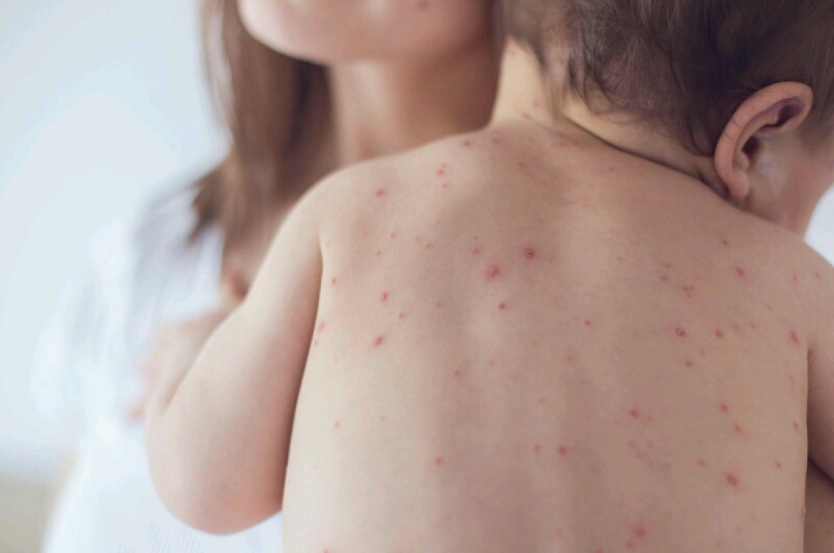    Врач из Новосибирска предупредила о массовой вспышке кори