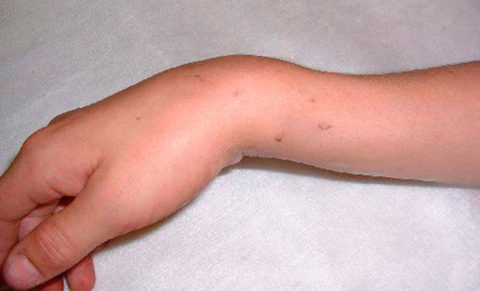  Перелом предплечья со смещением – сложная травма, опасная возможными осложнениями.