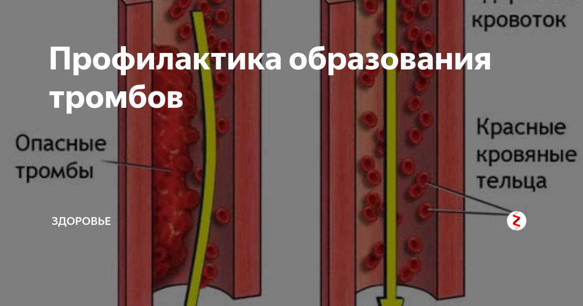 Флебит - виды, причины, признаки, симптомы, лечение
