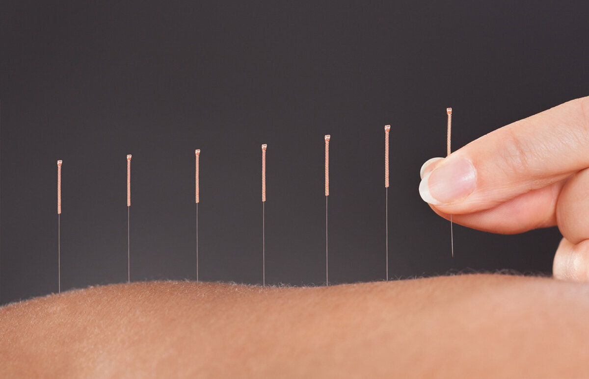 Иглоукалывание — Магический Эффект Плацебо | Здоровое тело — Здоровый ...