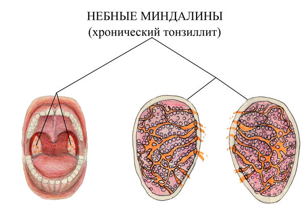 Рисунок: поражение небных миндалин при хроническом тонизиллите