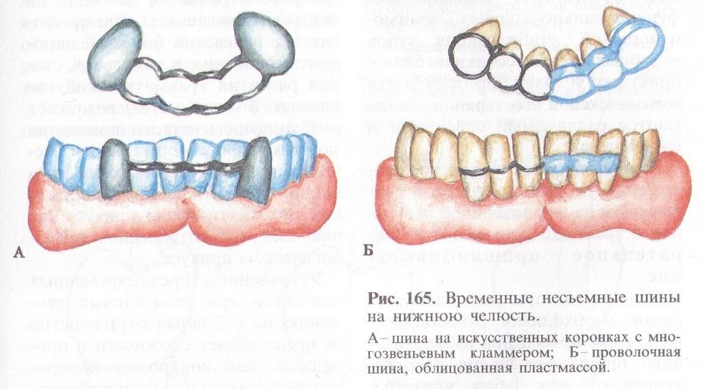 Шинирование зубов — Стоматология Династия