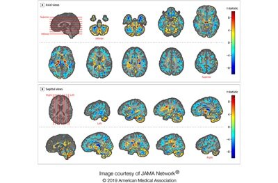 Мозг дипломатов уменьшился после службы на Кубе. Иллюстрация JAMA Network. 