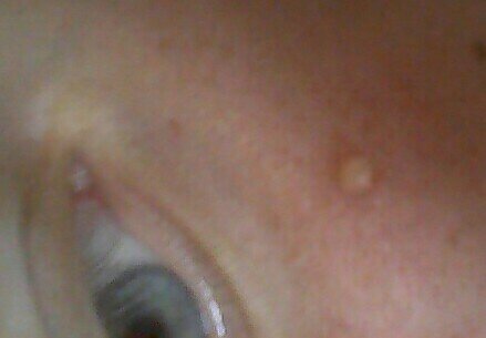 В народе порсянки или милиумы тоже называют жировики.Но в отличие от настоящих липом.от них можно легко избавиться. Конечно у косметолога во время чистки это было бы сделать правильнее . Но если нет возможности обратиться к специалисту.то расскажу.что можно сделать в домашних условиях . Порсянка это закрытая пора с белым содержимым.в отличие от камедона.поры имеющий выводной проток .видный как чёрная точка. Поэтому порсянку.чтобы удалить надо образовать выводной проток. И так.... Это место обрабатываем спиртовым раствором календулы .берем иголочку от стерильного шприца.прокалываем этот белый комочек. И можно удалять механически .как и комедон .надавливающим движением с двух сторон. Затем снова обработать календулой и сделать локально маску на основе глины.она будет дополнительно вытягивать содержимое и оказывать противовоспалительное и подсушивающее действие. Но поверьте мне безопаснее и даже приятнее обратиться к специалисту. 😊Будьте всегда на высоте .