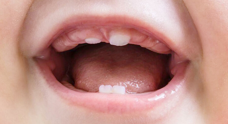 Синие десны у ребенка при прорезывании зубов