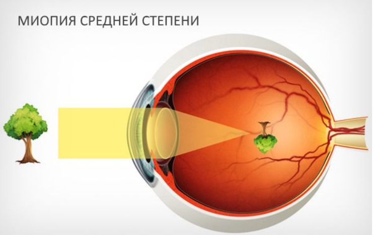 Современные методы лечения миопии у детей