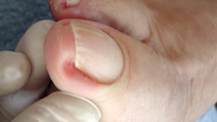 Вросшие ногти на ногах — причины и последствия