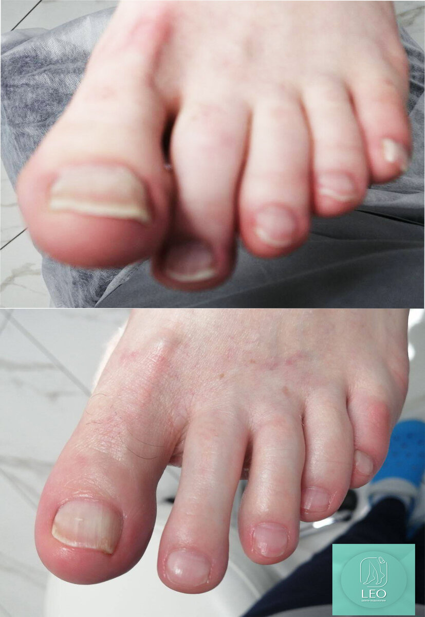 Медицинский аппаратный педикюр