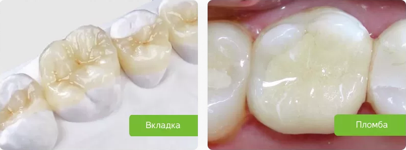 Варианты непрямой (вкладка) и прямой (пломба) реставрации зуба
