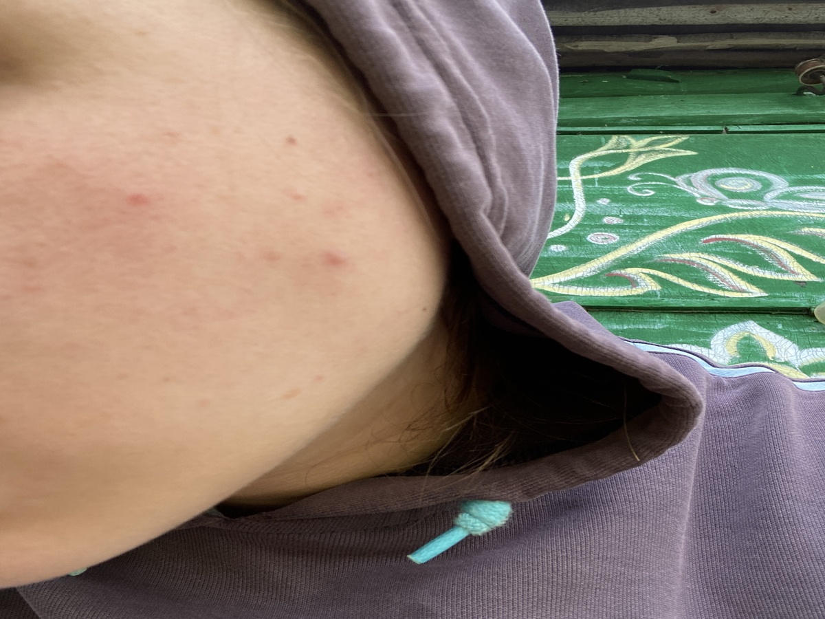 Моя малая часть прыщей 