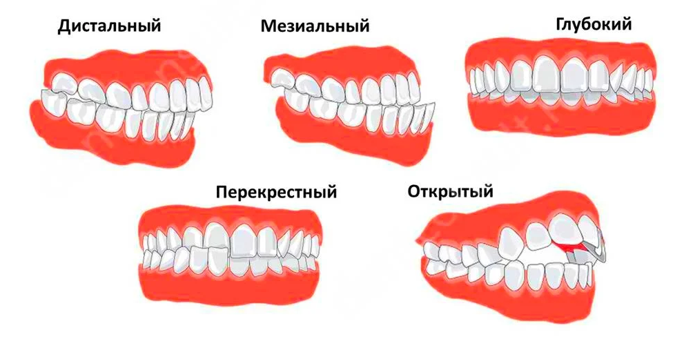 Правильный прикус у человека схема