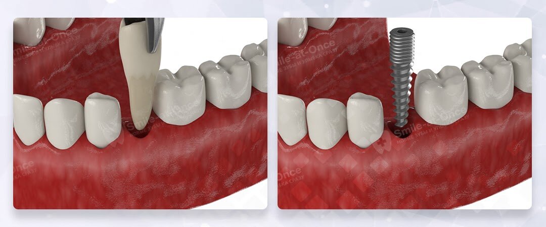 Можно ли поставить зубной имплант, если рядом нет зуба? | НК Клиник
