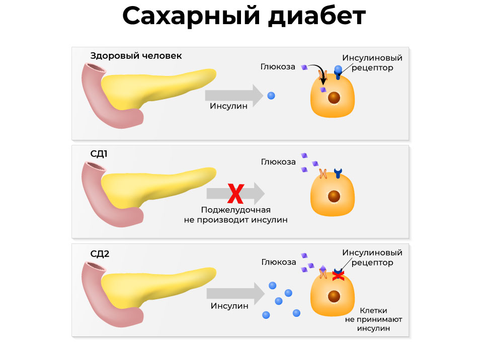 Инсулин и сахар в чем разница. Поджелудочная железа сахарный диабет 2 типа. Сахарный диабет 1 типа поджелудочная железа. Признаки СД 1 типа. СД 1 типа поджелудочной железы