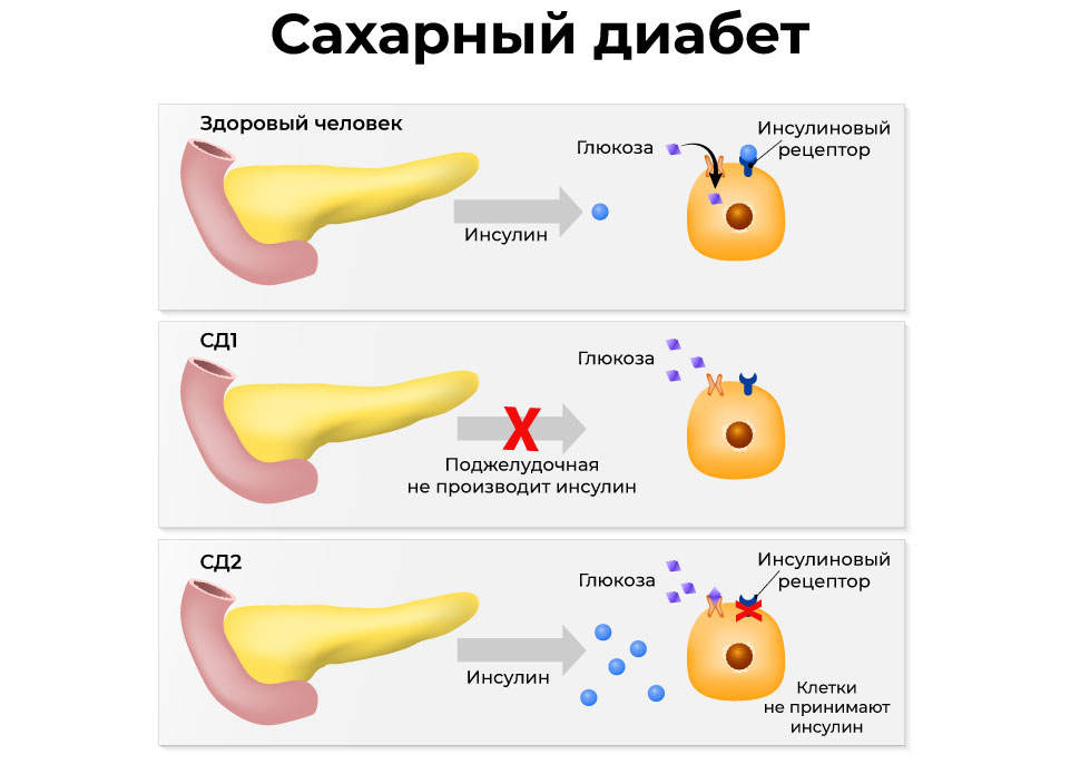 Короткий инсулин