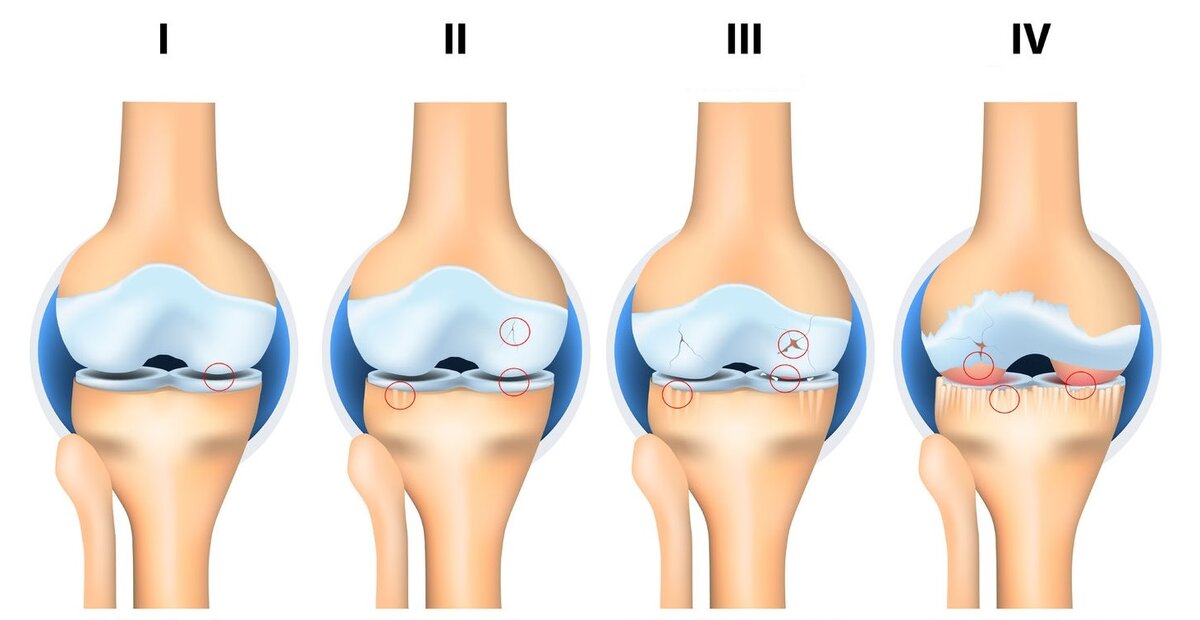 Истончение суставов. Источник: Яндекс-картинки