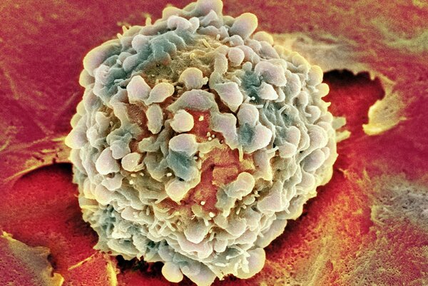 Cum arată o celulă canceroasă la microscop