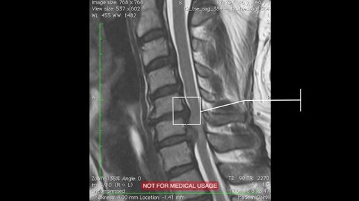 Шейный отдел позвоночника грыжа с7