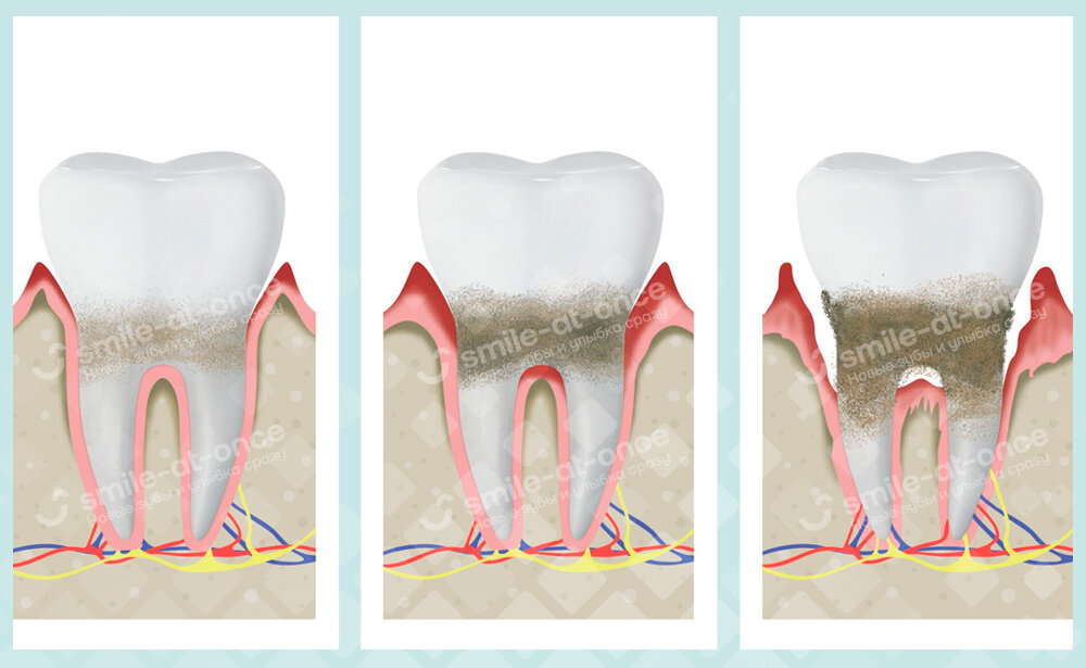 У тех, кто курит, зубной налет и камень образуются быстрее. А отсюда – по цепочке: кариес, воспаление десен, тканей вокруг корней, а там и потеря зубов. Фото: Smile-at-Once.ru. 