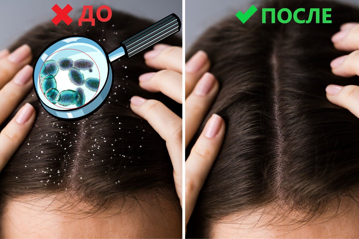 Что такое перхоть, и как ее лечить? Обьясняет врач | Косметолог Елена ...