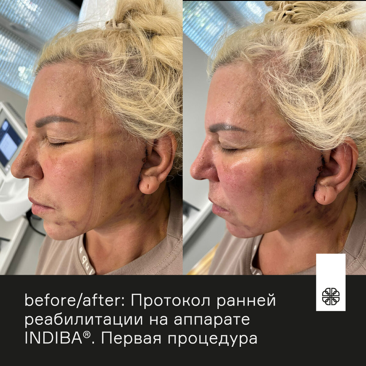 Индиба лицо до и после