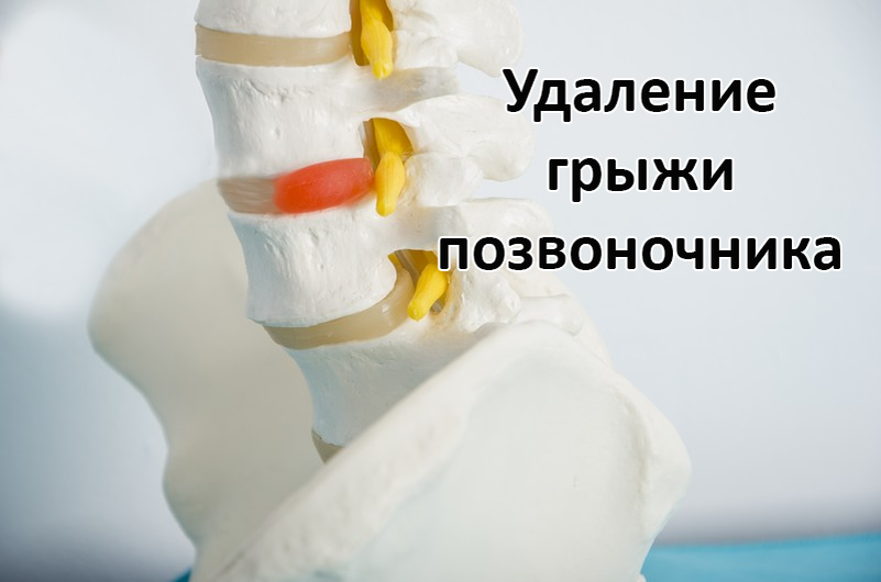 Грыжа позвоночника - вид изнутри