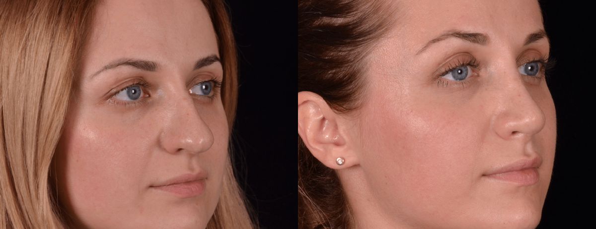 Риносептопластика толстого носа фото до и после. Фото с сайта Д.Р. Гришкяна. Имеются противопоказания, требуется консультация специалиста