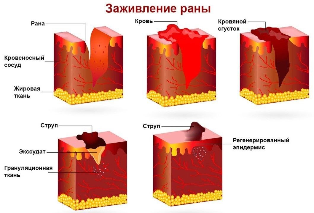 Что такое келоидный рубец | Маммология и хирургия РНЦРР | Дзен