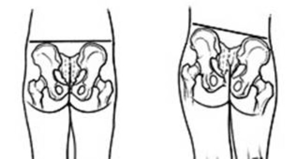 Как убрать таз у женщин. Перекос таза. Искривление таза. Перекос таза и стоп. Перекос костей таза.