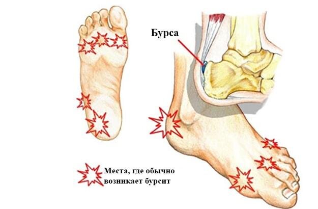 Ахиллобурсит, или бурсит стопы – симптомы, диагностика и лечение