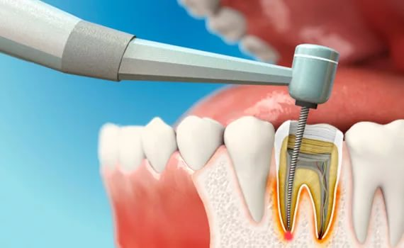 Болит зуб? Причины, симптомы и лечение зубной боли