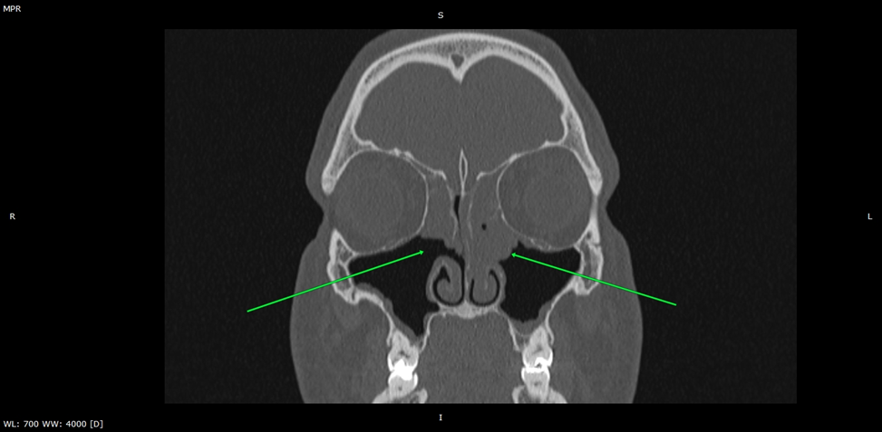 КТ ППН аксиальный срез. Соустья верхнечелюстных пазух расширены. Состояние после удаления крючковидных отростков