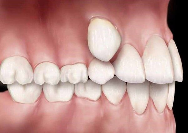 Рентген человека с гипердонтией (аномалия числа зубов) / зубы :: рентген :: крипота :: гипердонтия