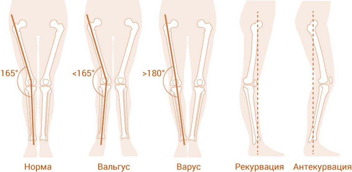 Вальгус норма