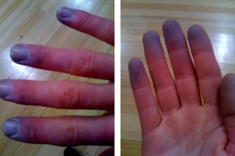 Посинение пальцев рук - причины и признаки, лечение и диагностика