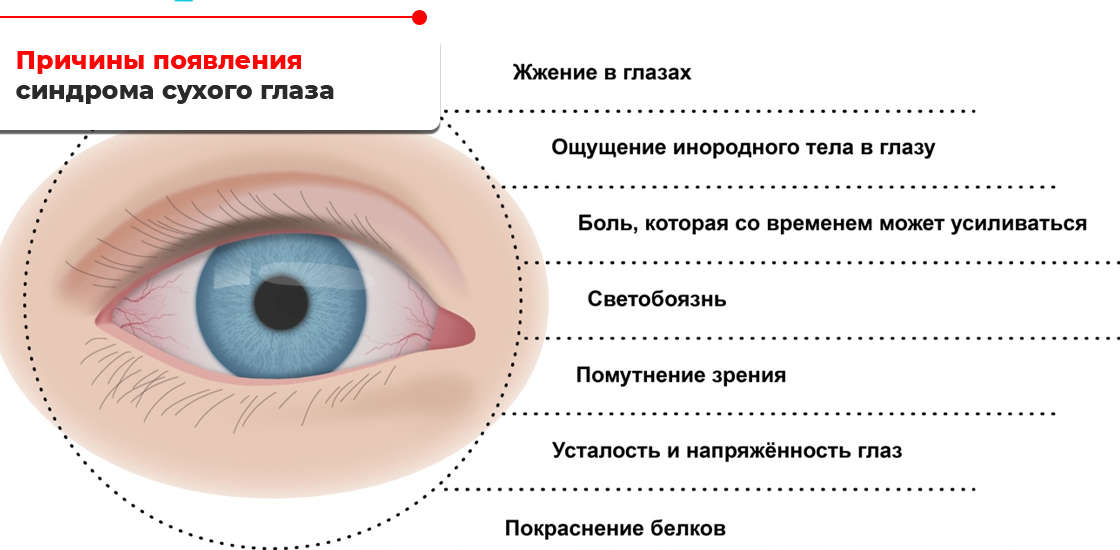 Почему появляется. Синдром сухого глаза симптомы причины развития. Кератит синдром сухого глаза. Синдром сухого глаза этиология. Синдром сухого глаза клинические проявления