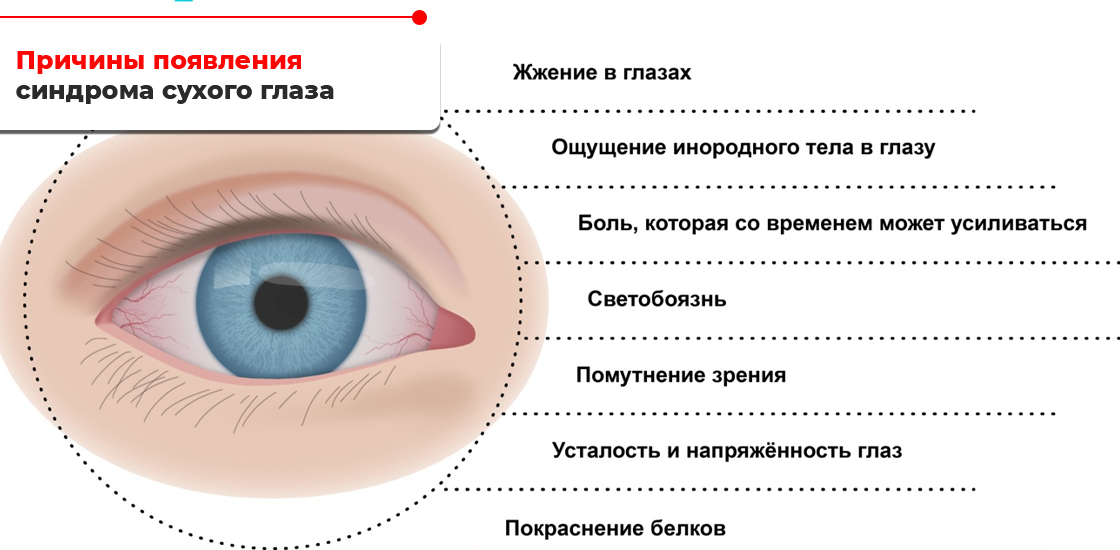 Почему появляется. Синдром сухого глаза симптомы причины развития. Кератит синдром сухого глаза. Синдром сухого глаза этиология. Синдром сухого глаза клинические проявления.